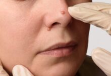 Remove Moles Naturally