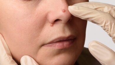 Remove Moles Naturally
