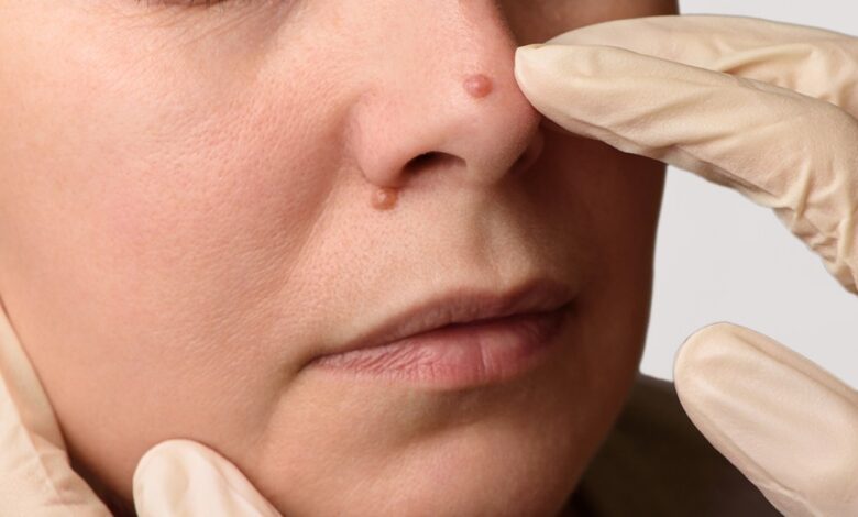 Remove Moles Naturally